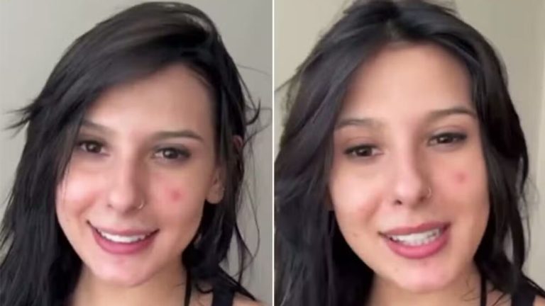 Remédio para acne usado por Ana Castela t