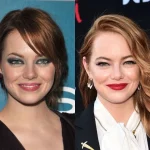 Emma Stone fez lifting facial Antes e depois em 35