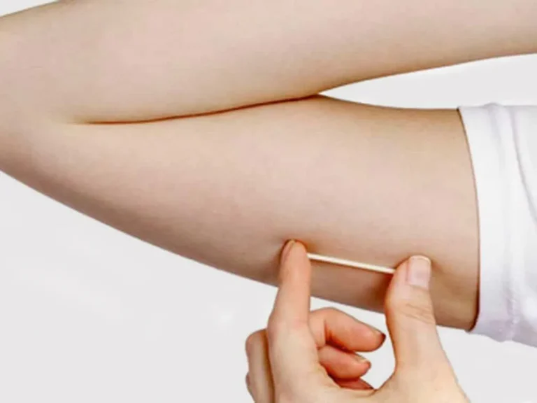 Implante contraceptivo que dura até 3 anos agora está disponíve